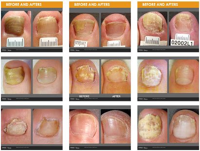 Exploring The Cost Of Laser Treatment For Toenail Fungus
